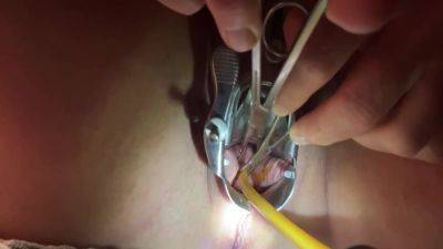 Tenaculum Grasping Cervix For Catheter 7 Min on vidfreenow.com